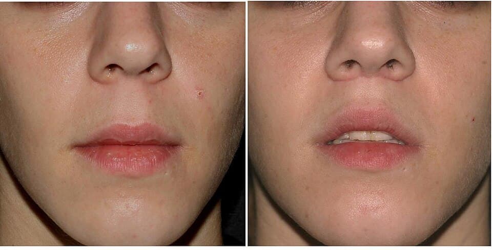 Lip Lift